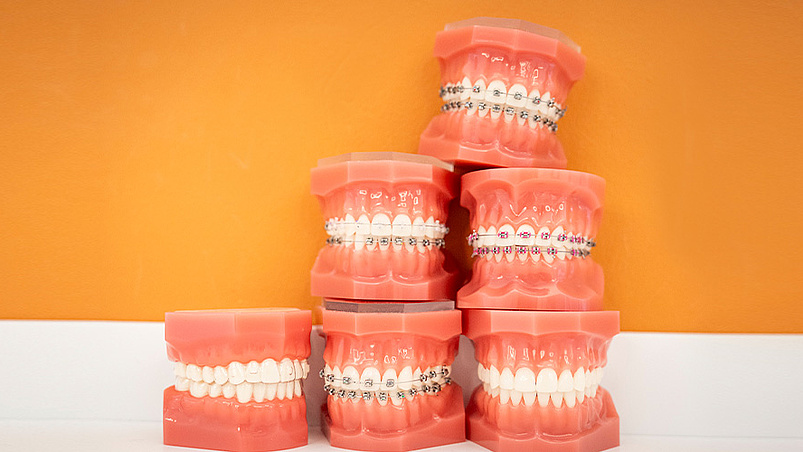 Zahnspangen für jedes Alter